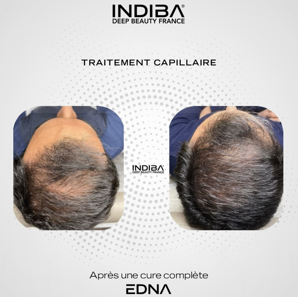soin capillaire chateaurenard anti perte de cheveux
